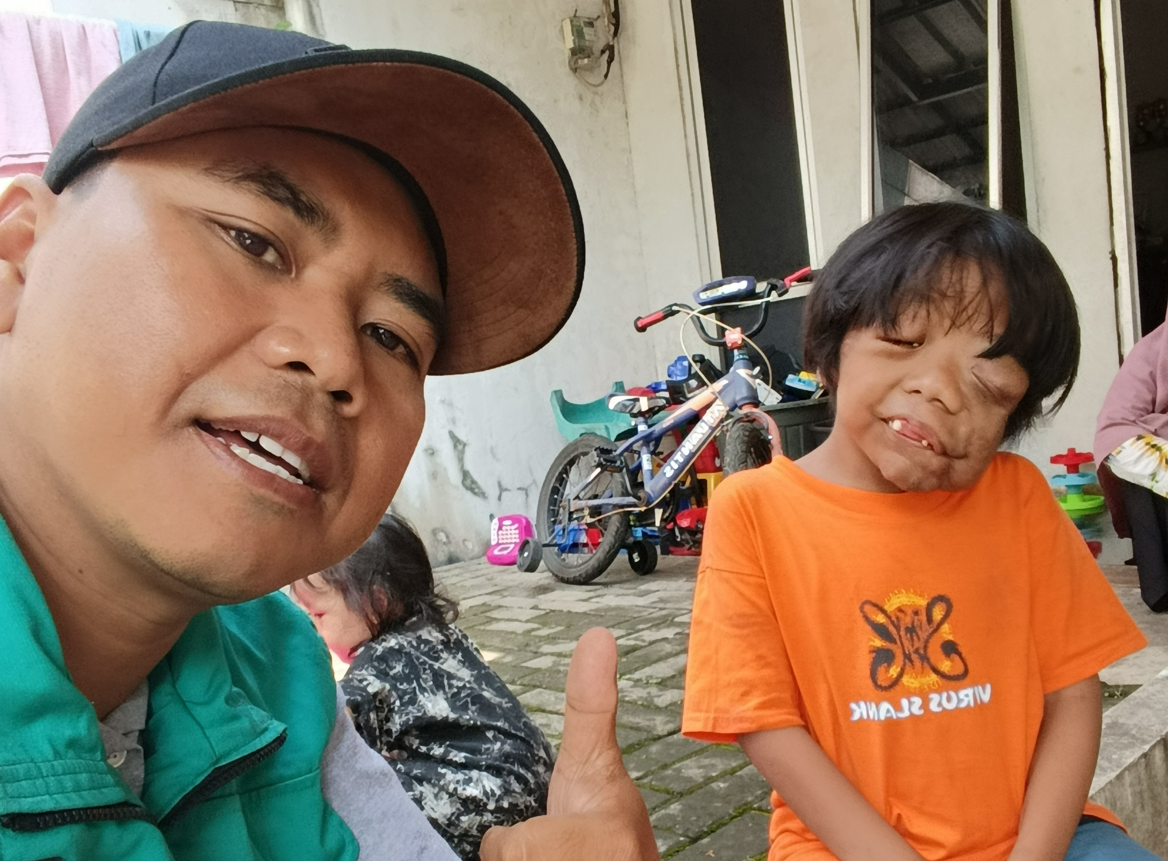 Miris!  Ilyas Bocah 8 Tahun, Dikucilkan Temannya Karena Penyakit Ini